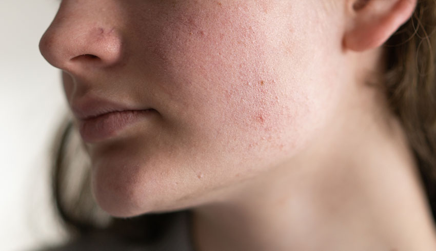 What Causes Blackheads? How Pores Become Congested 